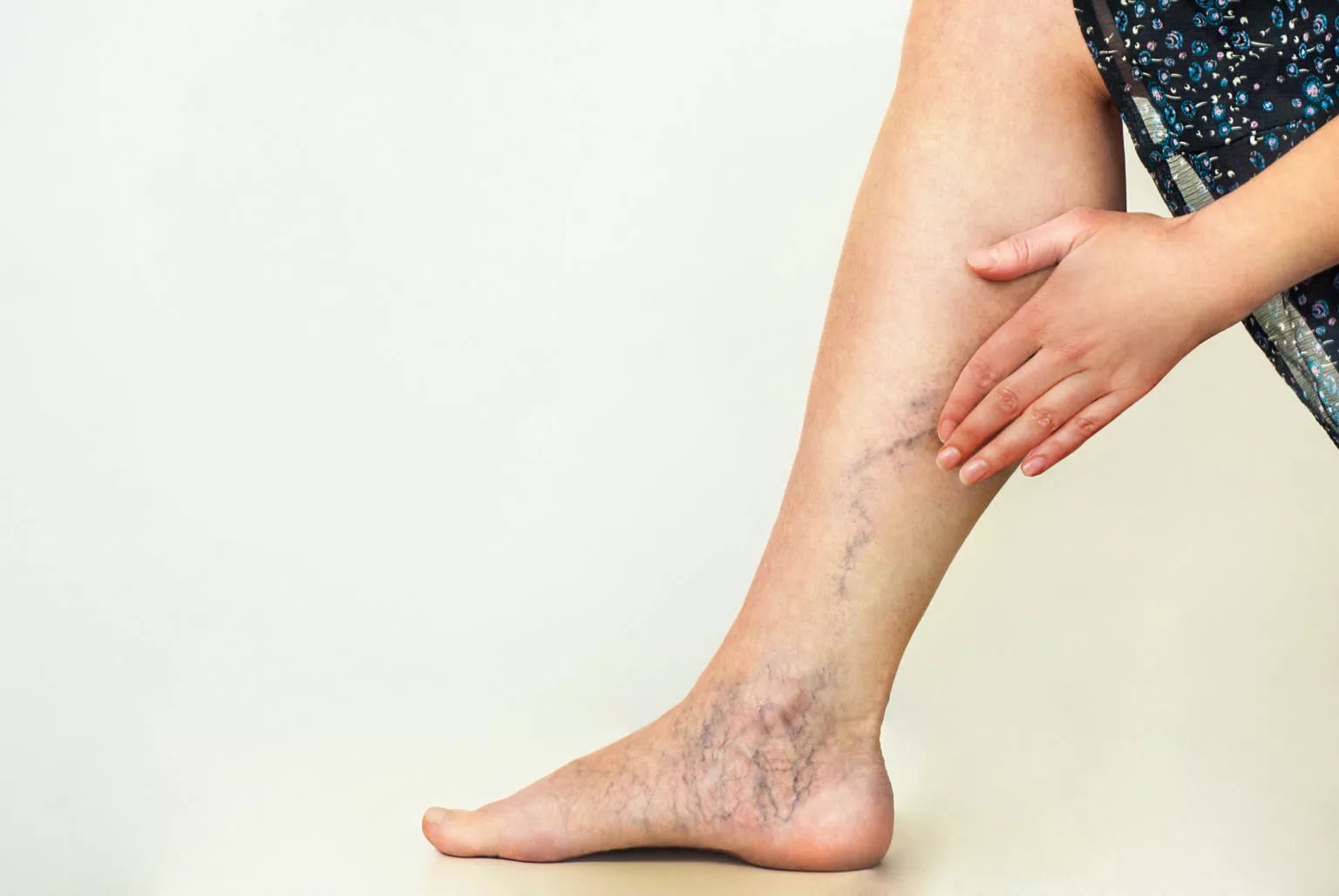 Blog 15 say goodbye to spider veins with sclerotherapy