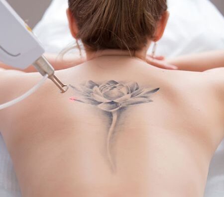 Portfolio 32 W Aesthetics and Wellness Services Tattoo Removal in Bend OR
