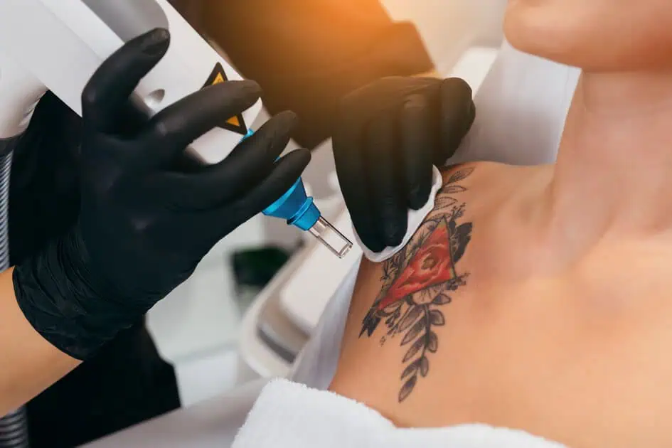 Tattoo Removal by W Aesthetics and Wellness in Bend, OR