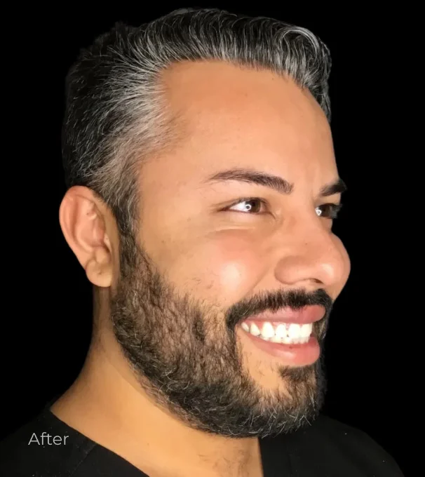 Real patient results before and after plastic surgery results in Bend, OR, performed by at W Aesthetics & Wellness