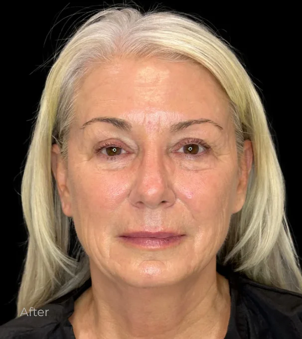 Mature woman with blonde hair showing facial rejuvenation results after cosmetic procedure
