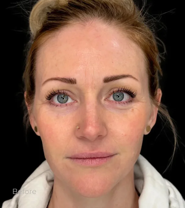 Real patient results before and after plastic surgery results in Bend, OR, performed by at W Aesthetics & Wellness