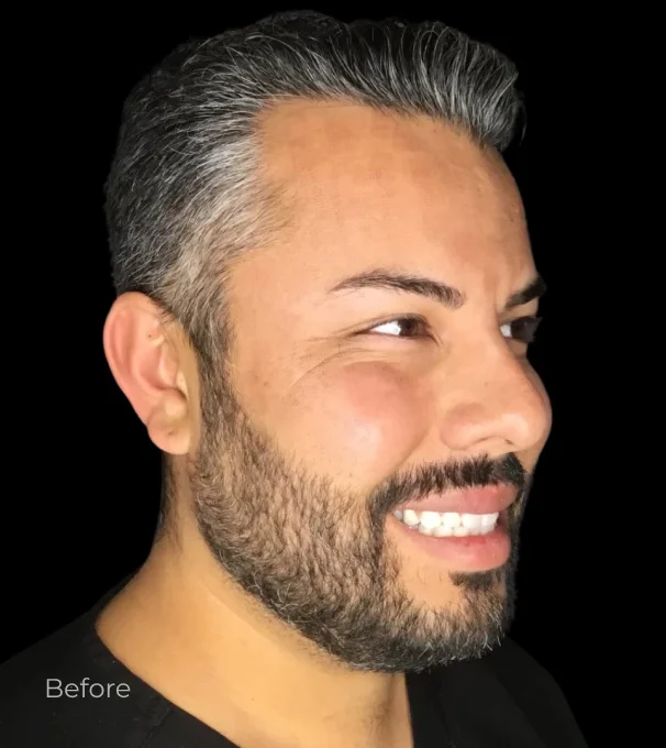 Real patient results before and after plastic surgery results in Bend, OR, performed by at W Aesthetics & Wellness