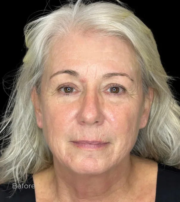 Mature woman with gray hair showing facial aging before cosmetic procedure treatment