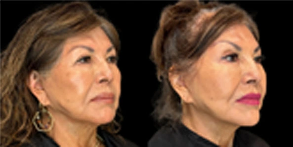 Real patient results before and after plastic surgery results in Bend, OR, performed by at W Aesthetics & Wellness