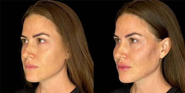 Real patient results before and after plastic surgery results in Bend, OR, performed by at W Aesthetics & Wellness