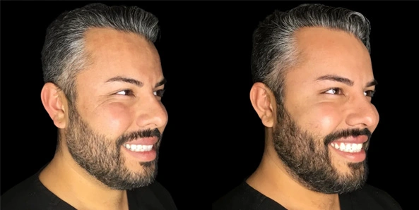 Real patient results before and after plastic surgery results in Bend, OR, performed by at W Aesthetics & Wellness