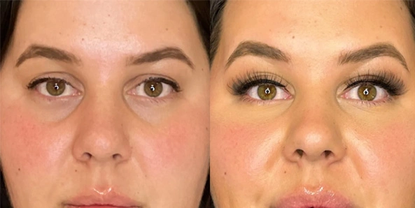 Real patient results before and after plastic surgery results in Bend, OR, performed by at W Aesthetics & Wellness