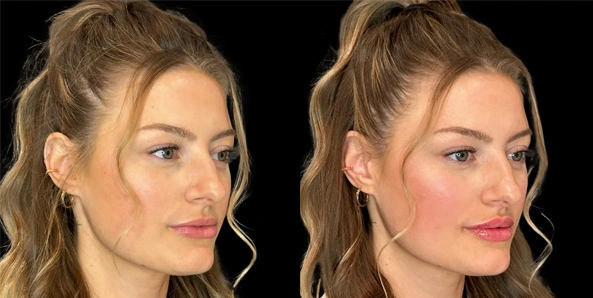 Real patient results before and after plastic surgery results in Bend, OR, performed by at W Aesthetics & Wellness