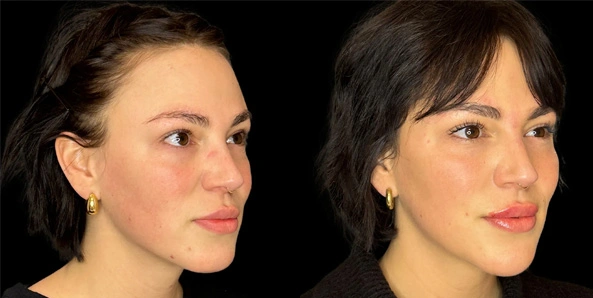 Real patient results before and after plastic surgery results in Bend, OR, performed by at W Aesthetics & Wellness