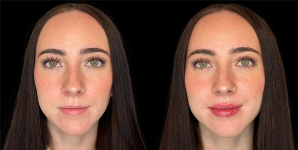 Real patient results before and after plastic surgery results in Bend, OR, performed by at W Aesthetics & Wellness