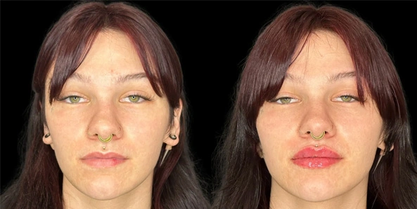 Real patient results before and after plastic surgery results in Bend, OR, performed by at W Aesthetics & Wellness