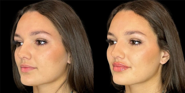 Real patient results before and after plastic surgery results in Bend, OR, performed by at W Aesthetics & Wellness