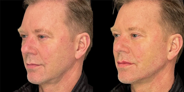 Real patient results before and after plastic surgery results in Bend, OR, performed by at W Aesthetics & Wellness