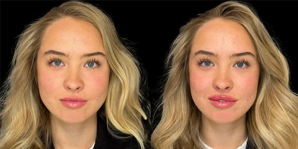 Real patient results before and after plastic surgery results in Bend, OR, performed by at W Aesthetics & Wellness
