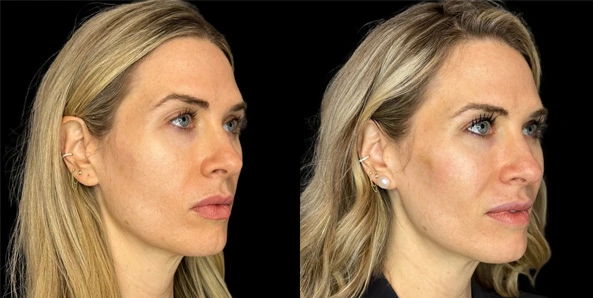 Real patient results before and after plastic surgery results in Bend, OR, performed by at W Aesthetics & Wellness