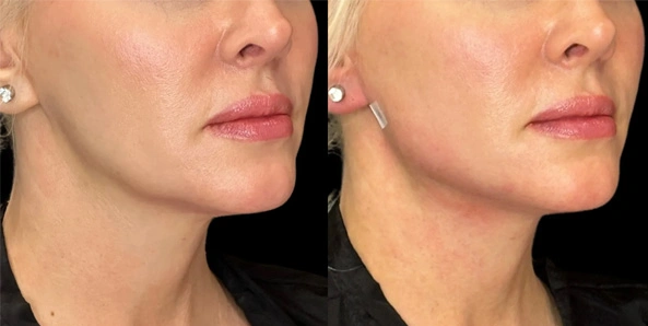 Real patient results before and after plastic surgery results in Bend, OR, performed by at W Aesthetics & Wellness