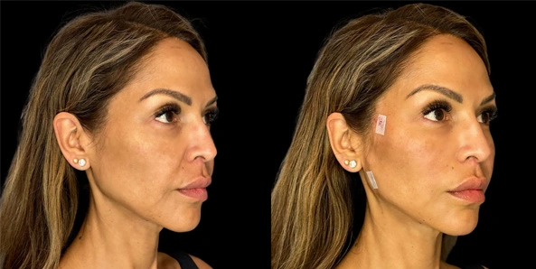 Real patient results before and after plastic surgery results in Bend, OR, performed by at W Aesthetics & Wellness