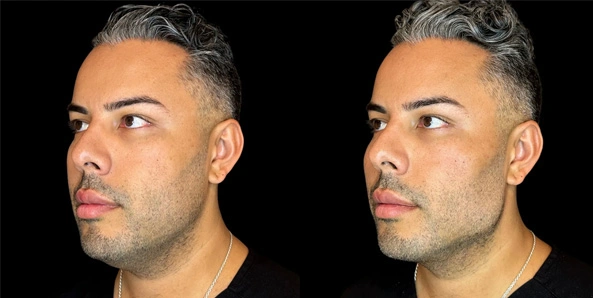 Real patient results before and after plastic surgery results in Bend, OR, performed by at W Aesthetics & Wellness