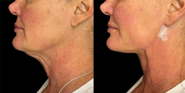 Real patient results before and after plastic surgery results in Bend, OR, performed by at W Aesthetics & Wellness