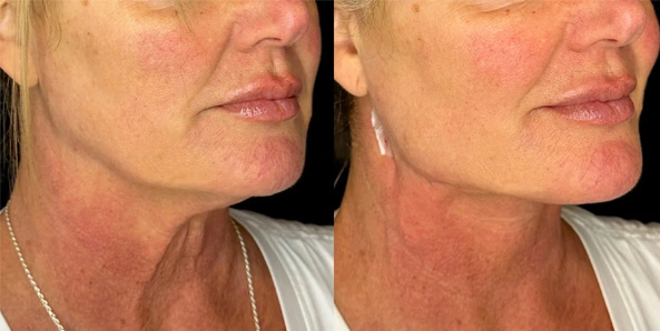 Real patient results before and after plastic surgery results in Bend, OR, performed by at W Aesthetics & Wellness