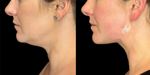 Real patient results before and after plastic surgery results in Bend, OR, performed by at W Aesthetics & Wellness