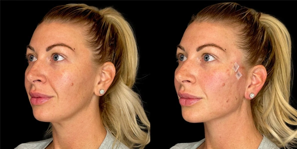 Real patient results before and after plastic surgery results in Bend, OR, performed by at W Aesthetics & Wellness