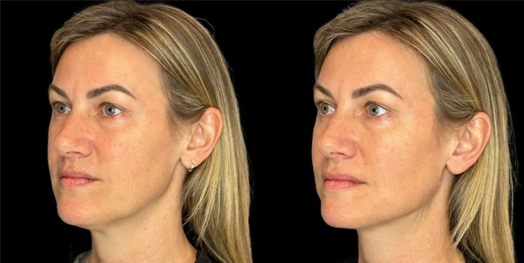 Real patient results before and after plastic surgery results in Bend, OR, performed by at W Aesthetics & Wellness