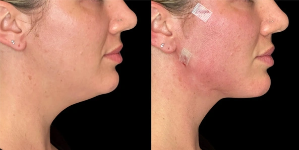 Real patient results before and after plastic surgery results in Bend, OR, performed by at W Aesthetics & Wellness