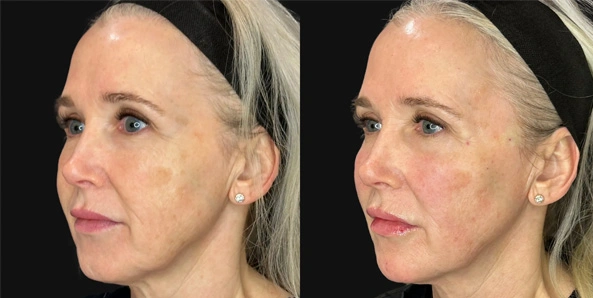 Real patient results before and after plastic surgery results in Bend, OR, performed by at W Aesthetics & Wellness