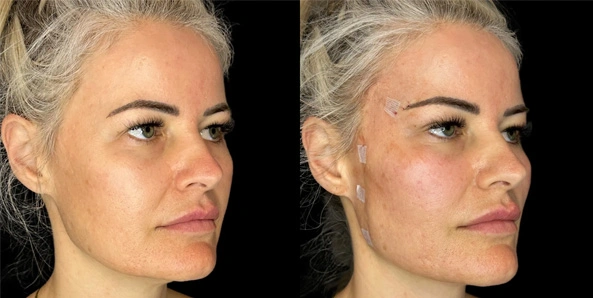 Real patient results before and after plastic surgery results in Bend, OR, performed by at W Aesthetics & Wellness