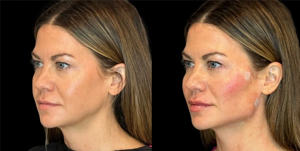 Real patient results before and after plastic surgery results in Bend, OR, performed by at W Aesthetics & Wellness