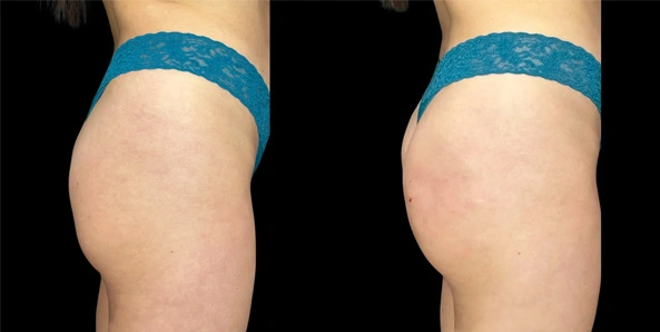 Real patient results before and after plastic surgery results in Bend, OR, performed by at W Aesthetics & Wellness