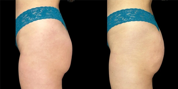 Real patient results before and after plastic surgery results in Bend, OR, performed by at W Aesthetics & Wellness