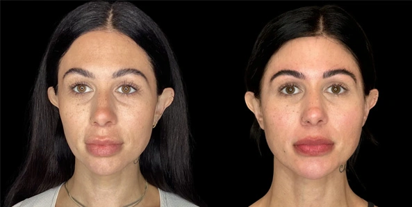 Real patient results before and after plastic surgery results in Bend, OR, performed by at W Aesthetics & Wellness