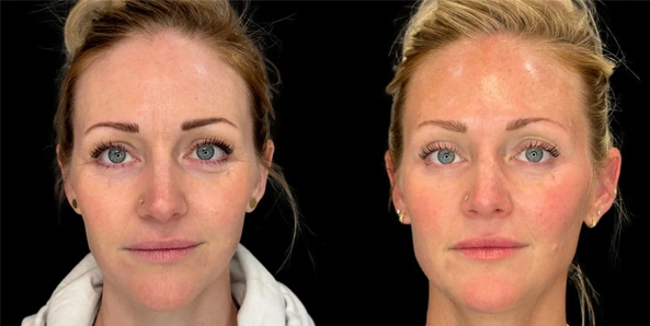 Real patient results before and after plastic surgery results in Bend, OR, performed by at W Aesthetics & Wellness