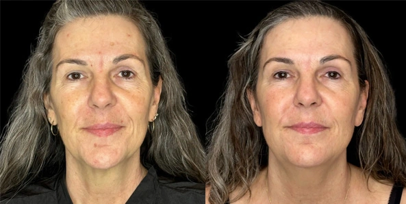 Real patient results before and after plastic surgery results in Bend, OR, performed by at W Aesthetics & Wellness
