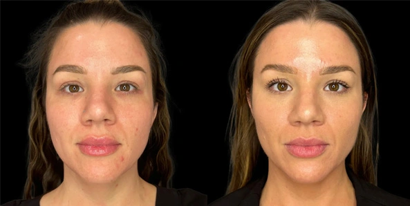 Real patient results before and after plastic surgery results in Bend, OR, performed by at W Aesthetics & Wellness