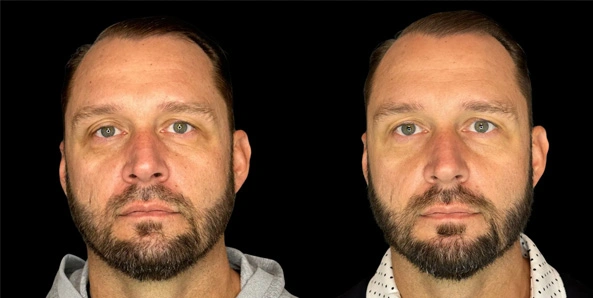 Real patient results before and after plastic surgery results in Bend, OR, performed by at W Aesthetics & Wellness