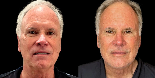 Real patient results before and after plastic surgery results in Bend, OR, performed by at W Aesthetics & Wellness