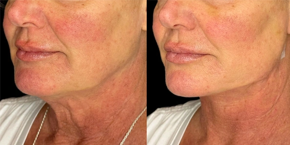 Real patient results before and after plastic surgery results in Bend, OR, performed by at W Aesthetics & Wellness