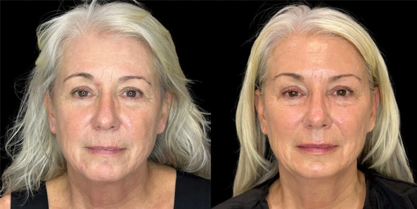 Real patient results before and after plastic surgery results in Bend, OR, performed by at W Aesthetics & Wellness