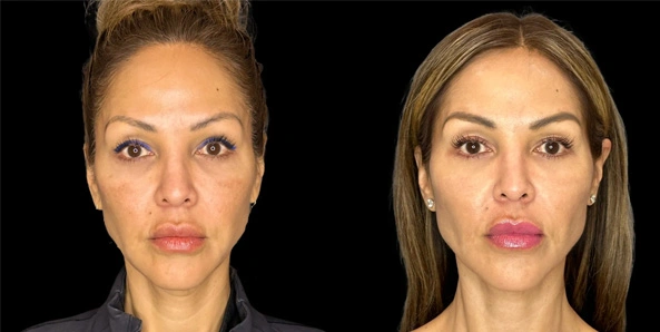 Real patient results before and after plastic surgery results in Bend, OR, performed by at W Aesthetics & Wellness