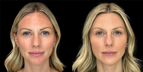 Real patient results before and after plastic surgery results in Bend, OR, performed by at W Aesthetics & Wellness