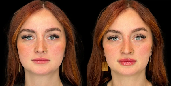 Real patient results before and after plastic surgery results in Bend, OR, performed by at W Aesthetics & Wellness