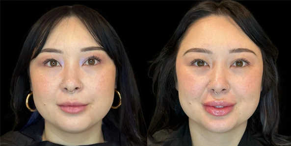 Real patient results before and after plastic surgery results in Bend, OR, performed by at W Aesthetics & Wellness