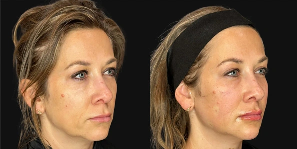 Real patient results before and after plastic surgery results in Bend, OR, performed by at W Aesthetics & Wellness