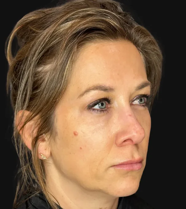 02-sculptra-1